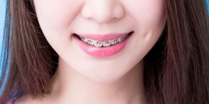 Perawatan Kawat Gigi Selain dengan Sikat Gigi